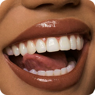 Veneers